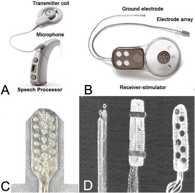 Auditory Brainstem Implants: Recent Progress and Future Perspectives